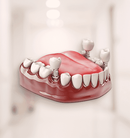 Imagem representando a estrutura bucal com implantes dentários