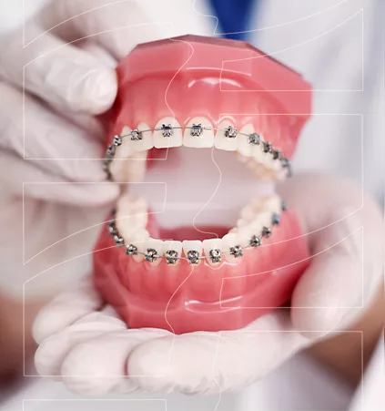 Mockup de estrutura dental com aparelho ortodôntico